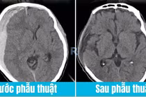 1 đêm sau cú vấp nhẹ, người đàn ông 55 tuổi bị tụ máu não nguy kịch