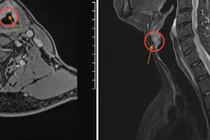 Khàn giọng tưởng hút thuốc, nói nhiều không ngờ ung thư thanh quản