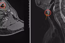 Khàn giọng tưởng hút thuốc, nói nhiều không ngờ ung thư thanh quản