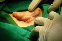 Phẫu thuật ca viêm sụn vành tai tái phát hiếm gặp