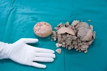 Sống chung sỏi bàng quang 30 năm, cô gái đau đớn vì sỏi 10cm