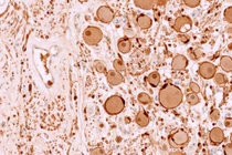 Điều trị sởi, bé 7 tuổi phát hiện khối u thần kinh hiếm gặp