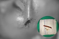 Tai nạn giao thông, người đàn ông bị nhánh cây cắm vào xuyên thái dương