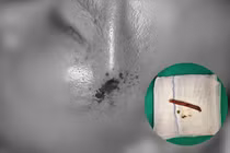 Tai nạn giao thông, người đàn ông bị nhánh cây cắm vào xuyên thái dương