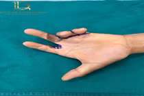 Phẫu thuật tạo hình điều trị sẹo co kéo phức tạp bàn ngón tay 25 năm