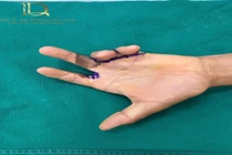 Phẫu thuật tạo hình điều trị sẹo co kéo phức tạp bàn ngón tay 25 năm