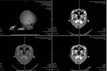 Tai nạn tại nhà, trẻ 6 tuổi ngừng tim, chấn thương sọ não nặng