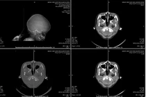 Tai nạn tại nhà, trẻ 6 tuổi ngừng tim, chấn thương sọ não nặng
