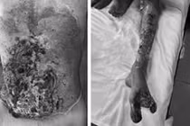 Đắp lá chữa bỏng, thanh niên 22 tuổi bị hoại tử nghiêm trọng