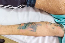 Da bong tróc do tắm lá chữa sởi