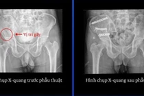 Gãy xương nguy kịch vì tự sửa mái nhà