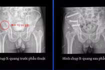 Gãy xương nguy kịch vì tự sửa mái nhà