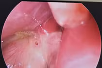 Cảnh báo nguy cơ thủng dạ dày ở trẻ em ngày càng tăng