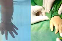 Dị tật bẩm sinh ngón tay thừa gây mất chức năng vận động