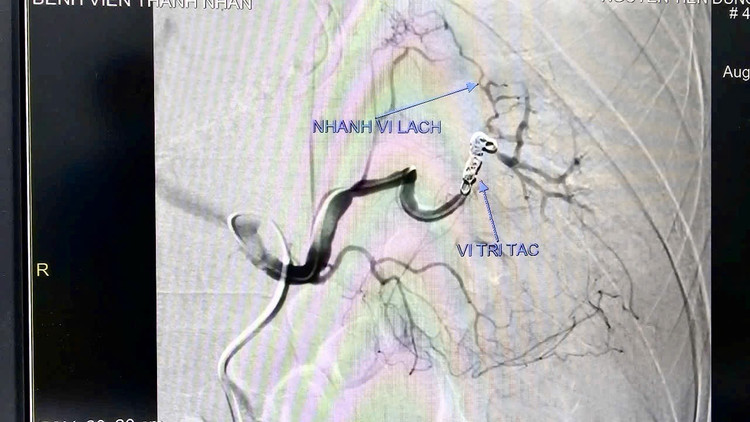 Hình ảnh chụp động mạch lách của bệnh nhân. Ảnh BV