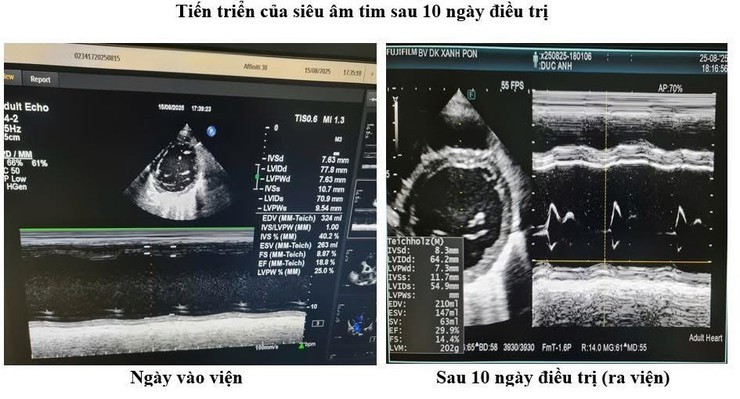 Tiến triển của siêu âm tim phổi sau 10 ngày điều trị. Ảnh BV Tiến triển của siêu âm tim phổi sau 10 ngày điều trị. Ảnh BV