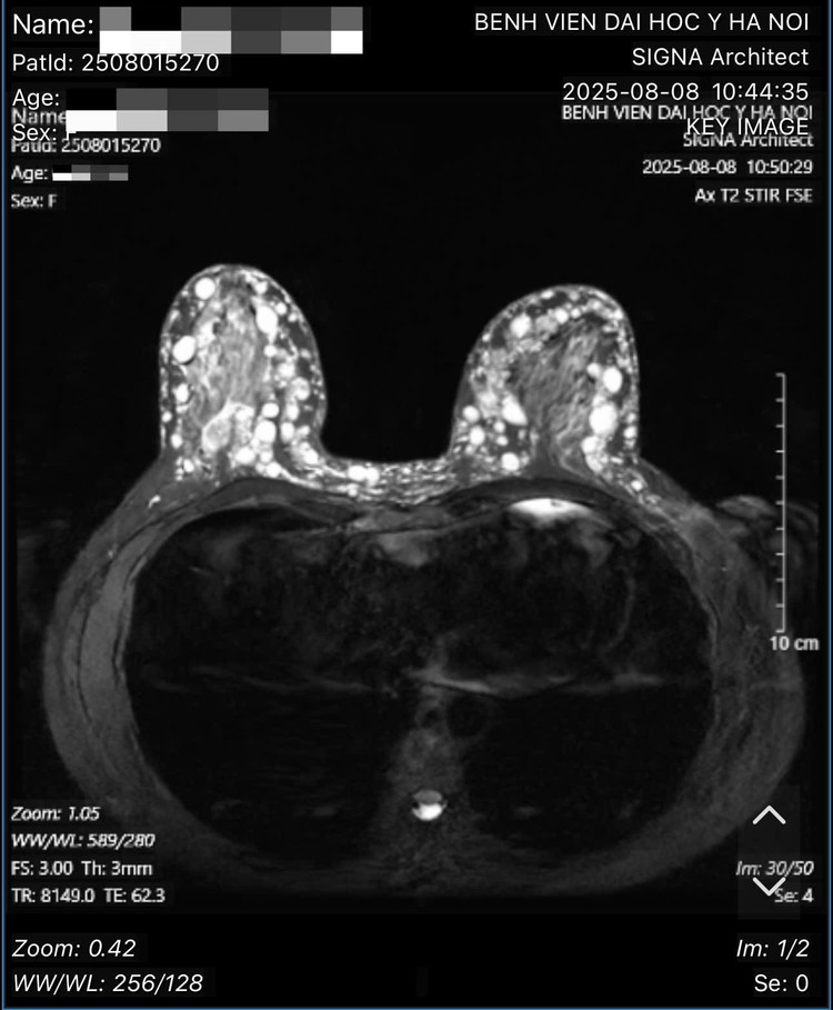 Hình ảnh các hạt sillicone tại ngực bệnh nhân. Ảnh BSCC/Nguồn daibieunhandan.vn