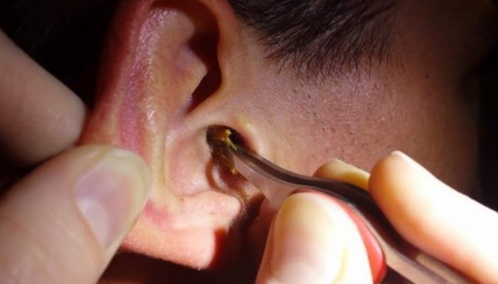 Nếu côn trùng chui vào tai có kích thước lớn thì cần làm nó chết trước khi lấy ra ngoài để tránh làm tổn thương ống tai. Ảnh minh họa/Nguồn Bệnh viện Hồng Ngọc Nếu côn trùng chui vào tai có kích thước lớn thì cần làm nó chết trước khi lấy ra ngoài để tránh làm tổn thương ống tai. Ảnh minh họa/Nguồn Bệnh viện Hồng Ngọc