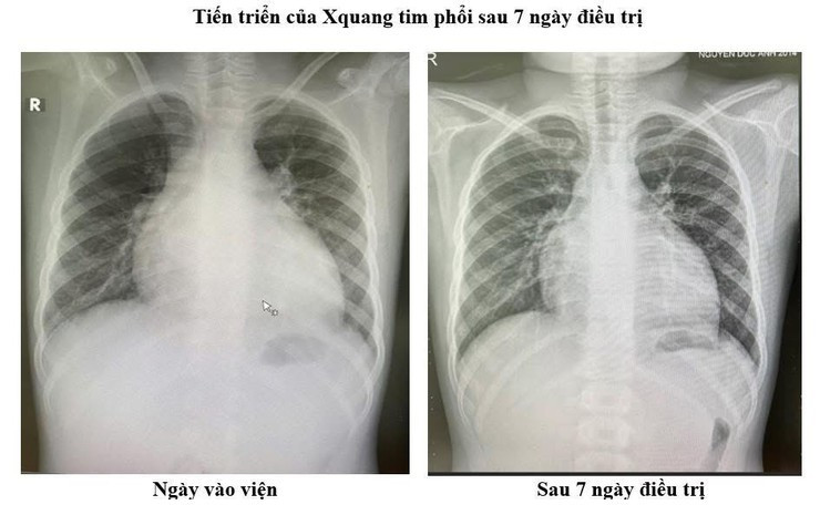 Tiến triển của X-quang tim phổi sau 7 ngày điều trị. Ảnh BV Tiến triển của X-quang tim phổi sau 7 ngày điều trị. Ảnh BV