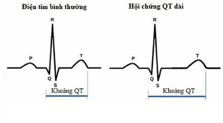 Hình ảnh mô tả hội chứng QT kéo dài trên điện tâm đồ. Ảnh vinmec.com Hình ảnh mô tả hội chứng QT kéo dài trên điện tâm đồ. Ảnh vinmec.com
