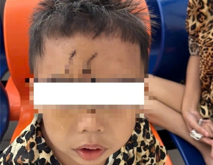 Bé trai 5 tuổi bị chó cắn gây biến dạng khuôn mặt hiện đã lành các vết thương. Ảnh BV Bé trai 5 tuổi bị chó cắn gây biến dạng khuôn mặt hiện đã lành các vết thương. Ảnh BV
