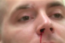 Dấu hiệu không ngờ cảnh báo bạn bị ung thư máu