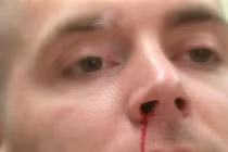 Dấu hiệu không ngờ cảnh báo bạn bị ung thư máu