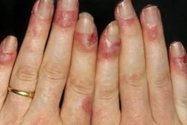 Mẹo hay trị cước chân tay những ngày rét đậm, rét hại