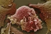 Sự phá huỷ tàn khốc của tế bào ung thư