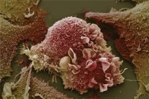 Sự phá huỷ tàn khốc của tế bào ung thư