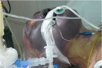 Một bệnh nhân tử vong do ăn tiết canh lợn