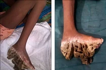 Thương tâm 3 chị em mắc bệnh lạ chân nở như hoa