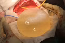 Cận cảnh nang sán to như quả bóng trong đầu bé 12 tuổi