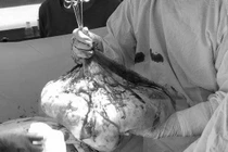 Người phụ nữ bụng to hơn chửa vì khối u nặng 35kg 