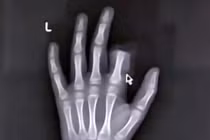 Bị mẹ cấm dùng smartphone, bé 11 tuổi tự cắt lìa ngón tay