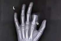 Bị mẹ cấm dùng smartphone, bé 11 tuổi tự cắt lìa ngón tay