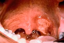 Những con số kinh hoàng về dịch bệnh bạch hầu 