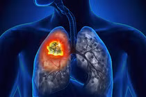 Những con số giật mình về ung thư phổi tại Việt Nam
