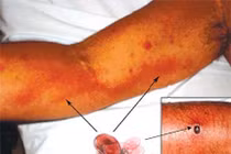 Những điều cần biết về virus gây bệnh sốt mò nguy hiểm