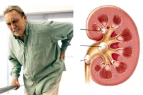 7 sự thật hầu hết mọi người đều hiểu sai về sỏi thận