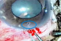 Hãi hùng giun đũa chó sống trong mắt một người phụ nữ