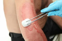 Cách sơ cứu khi bị bỏng điện, điện giật