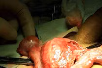 Hy hữu trường hợp mang cơ quan sinh sản sai giới tính