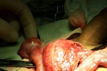 Hy hữu trường hợp mang cơ quan sinh sản sai giới tính