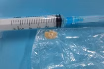 Một trẻ suýt tử vong vì hóc mít