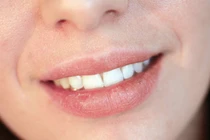 Bệnh tật đằng sau triệu chứng nứt nẻ môi