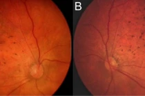 Virus Zika ăn não người có thể gây mù mắt