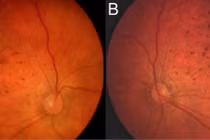 Virus Zika ăn não người có thể gây mù mắt