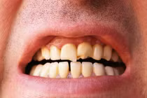 Mổ xẻ tác hại khủng khiếp do nhai kẹo cao su