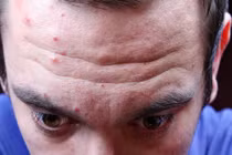 Bí mật những bệnh hiểm nghèo có thể chẩn đoán qua mụn